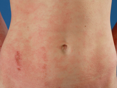 Atopisch eczeem elleboogplooien