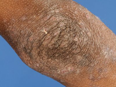 Atopisch eczeem elleboogplooien