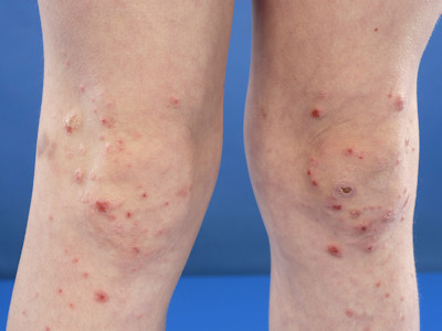 Atopisch eczeem elleboogplooien