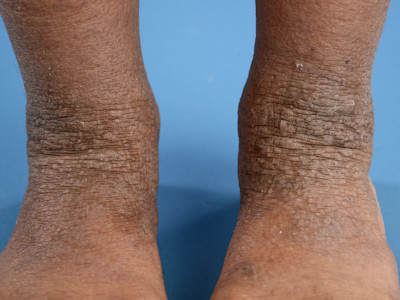 Atopisch eczeem van de knieholten