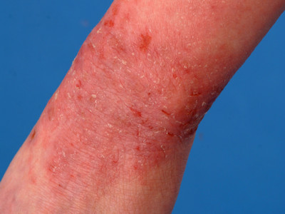 Atopisch eczeem van de knieholten