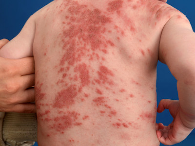Atopic dermatitis