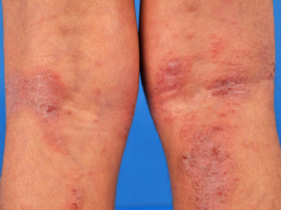 Atopisch eczeem elleboogplooien