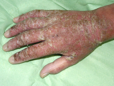 Atopisch eczeem van de knieholten