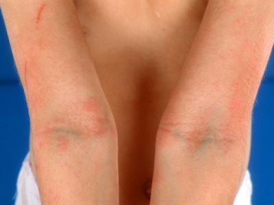Atopic dermatitis