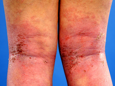 Atopic dermatitis