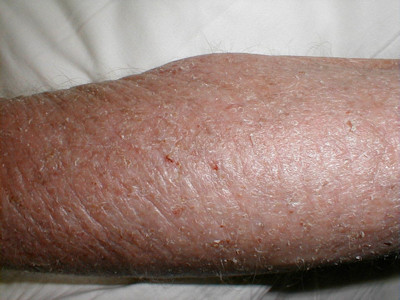 Dry skin in atopic dermatitis