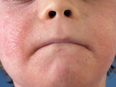 Atopisch eczeem elleboogplooien