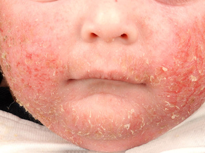 Dew worm, atopic eczema in infants