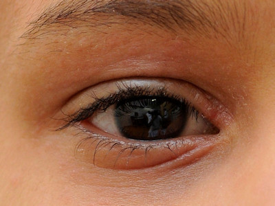 Atopisch eczeem elleboogplooien