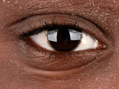 Atopisch eczeem van de knieholten