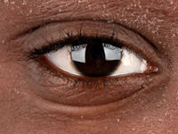 Atopisch eczeem bij donkere huid, Dennie-Morgan plooien