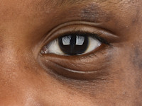 Atopisch eczeem bij donkere huid, Dennie-Morgan plooien