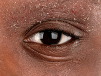 Atopisch eczeem bij donkere huid, Dennie-Morgan plooien