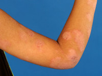 Atopisch eczeem bij donkere huid, psoriatiform atopisch eczeem