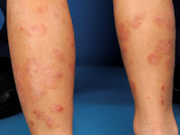 Atopisch eczeem bij donkere huid, psoriatiform atopisch eczeem