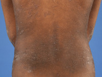 Atopisch eczeem bij donkere huid