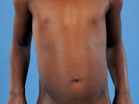 Atopisch eczeem bij donkere huid