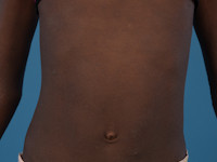 Atopisch eczeem bij donkere huid