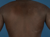 Atopisch eczeem bij donkere huid