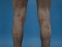 Atopisch eczeem bij donkere huid, droge huid