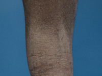 Atopisch eczeem bij donkere huid, droge huid