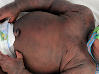 Atopisch eczeem bij donkere huid, erytheem