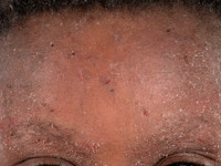 Atopisch eczeem bij donkere huid, erytheem