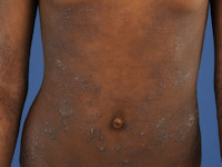 Atopisch eczeem bij donkere huid, folliculair eczeem