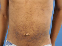 Atopisch eczeem bij donkere huid, folliculair eczeem