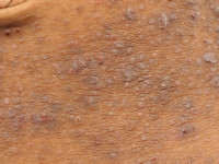 Atopisch eczeem bij donkere huid, folliculair eczeem