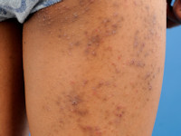 Atopisch eczeem bij donkere huid, folliculair eczeem