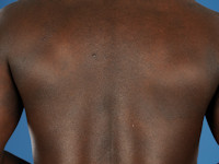 Atopisch eczeem bij donkere huid, folliculair eczeem