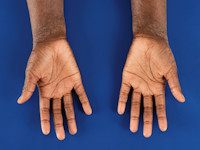 Atopisch eczeem bij donkere huid, hyperlineariteit van de handpalmen