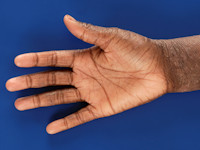 Atopisch eczeem bij donkere huid, hyperlineariteit van de handpalmen