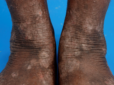 Atopisch eczeem bij donkere huid, lichenificatie