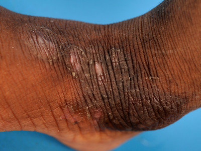 Atopisch eczeem bij donkere huid, lichenificatie