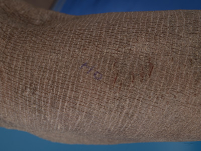 Atopisch eczeem bij donkere huid, lichenificatie