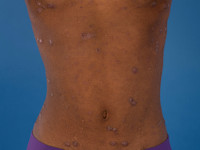 Atopisch eczeem bij donkere huid, papuleus eczeem