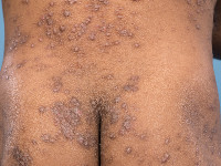 Atopisch eczeem bij donkere huid, papuleus eczeem