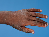 Atopisch eczeem bij donkere huid, papuleus eczeem