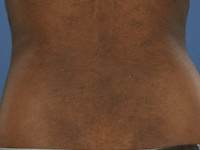 Atopisch eczeem bij donkere huid, post-inflammatoire hyperpigmentatie