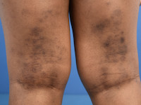 Atopisch eczeem bij donkere huid, post-inflammatoire hyperpigmentatie