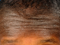 Atopisch eczeem bij donkere huid, post-inflammatoire hyperpigmentatie