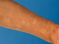 Atopisch eczeem bij donkere huid, post-inflammatoire hypopigmentatie