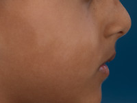 Atopisch eczeem bij donkere huid, post-inflammatoire hypopigmentatie