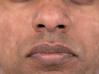 Atopisch eczeem bij donkere huid, post-inflammatoire hypopigmentatie