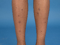 Atopisch eczeem bij donkere huid, prurigo nodularis (Besnier)