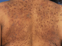 Atopisch eczeem bij donkere huid, prurigo nodularis (Besnier)