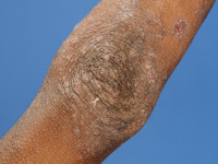 Atopisch eczeem bij donkere huid, strekzijden